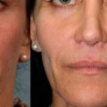 Can You Have a Facial with Fillers?