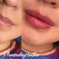 Lip Fillers and Hyaluronic acid