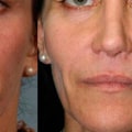 Can I Get a Facial Before Fillers?