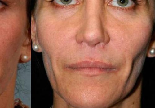 The Benefits of Facial Fillers: A Comprehensive Guide