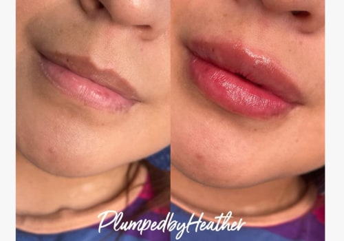 Lip Fillers and Hyaluronic acid